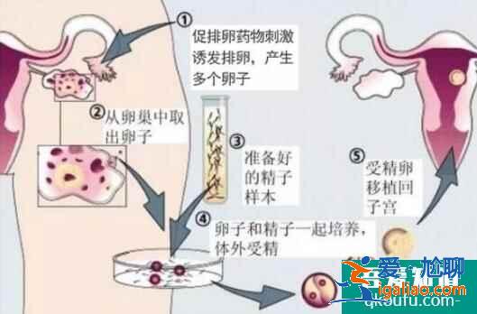 人工授精多次失敗后還可以做試管嬰兒?jiǎn)?？