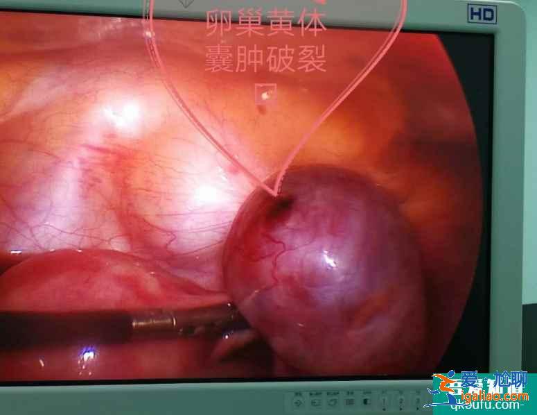 卵泡破裂是怎么回事？卵泡破了沒懷孕怎么辦？