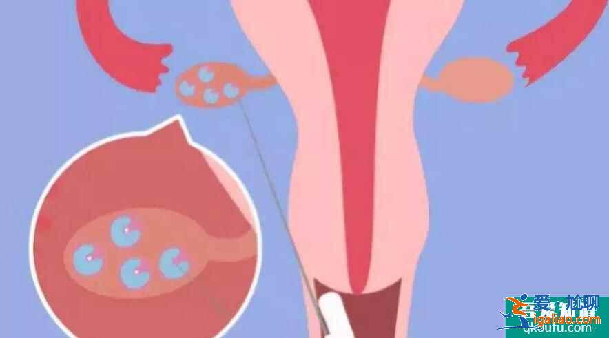 腹部取卵手術(shù)是什么？？