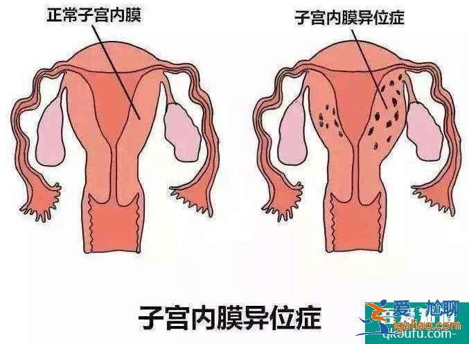 試管嬰兒超長方案好不好？費用多少？？