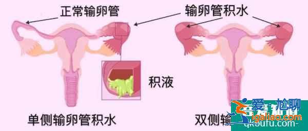 輸卵管積水的女性赴美做試管嬰兒，有什么樣的方案？？