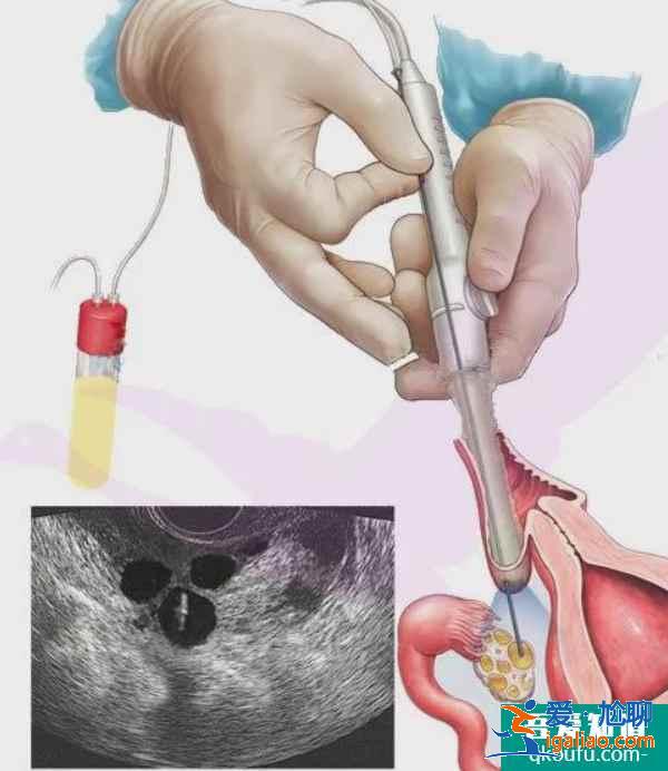 答疑：試管促排取卵后出現(xiàn)腹脹正常嗎？如何應(yīng)對？？
