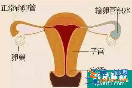 輸卵管積水還能做試管嬰兒嗎？是否會對試管成功率有影響？？
