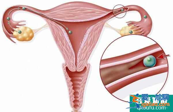 女性宮腔積水做試管嬰兒的成功率有多高？？
