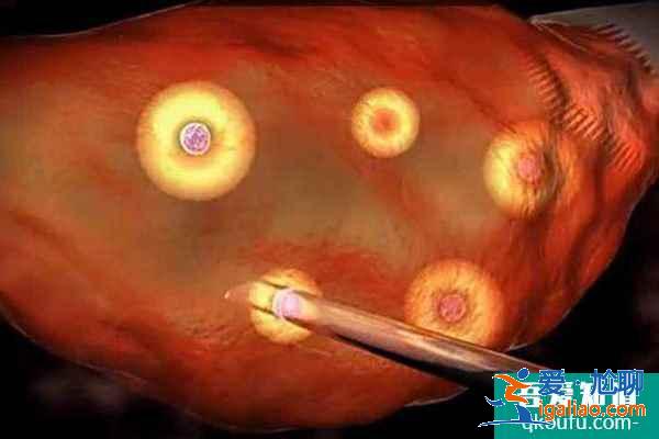 試管嬰兒專家解析：促排/取卵是否會導(dǎo)致腹腔積水？？