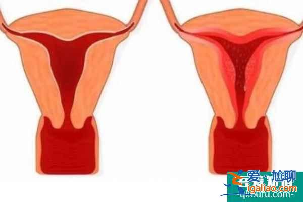 子宮內(nèi)膜薄由什么因素所致，試管嬰兒如何提高成功率？？