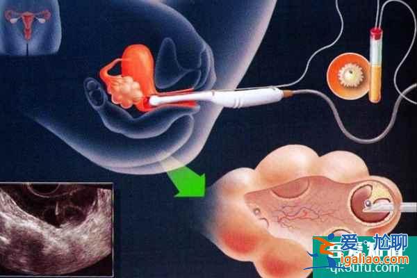 試管嬰兒為子宮腺肌癥患者保孕護(hù)航？