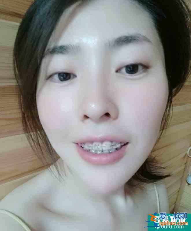32歲 那年我戴上了牙套，身邊一片八卦？