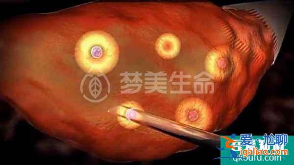 赴美試管嬰兒流程詳細(xì)分解，完善攻略推薦!？