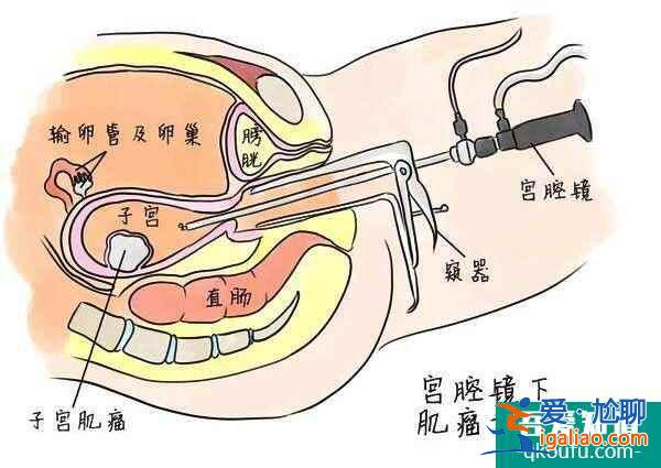 試管嬰兒助多發(fā)性子宮肌瘤女性贏好孕人生？