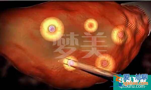單身女性赴美做試管嬰兒攻略：需做好準(zhǔn)備？