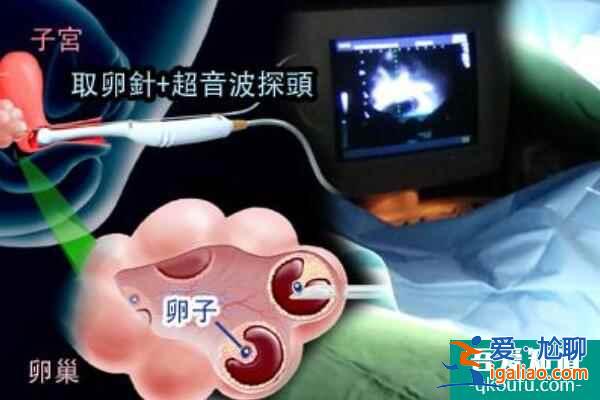 試管嬰兒：輸卵管囊腫會影響胚胎移植嗎？？