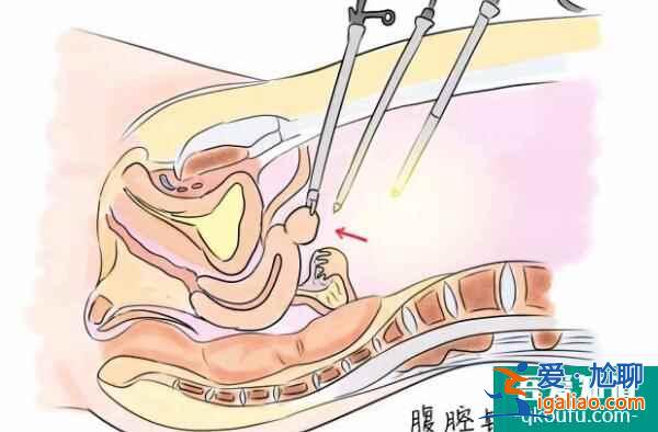 試管嬰兒：輸卵管囊腫會影響胚胎移植嗎？？