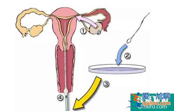 女性雙側(cè)輸卵管堵塞還可以赴美做試管嬰兒嗎？？