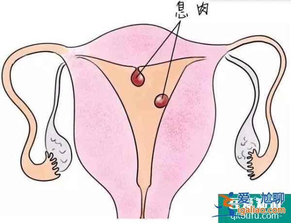 患有子宮息肉可以去做試管嬰兒嗎？？