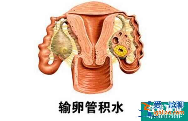 輸卵管異常阻斷的孕育路，赴美做試管搭建“好孕鵲橋”？