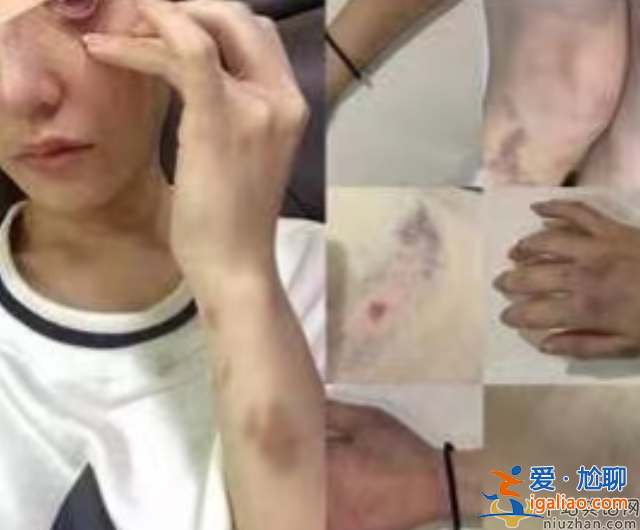 網(wǎng)紅蔡瑛紋被男友家暴致流產(chǎn)，控訴男方吃軟飯還劈腿