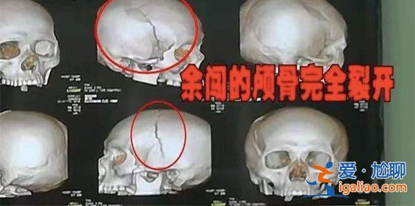 被打破頭骨女生已清醒，家屬回應(yīng)頭骨打碎看這一點(diǎn)[家屬回應(yīng)頭骨打碎看這一點(diǎn)]？
