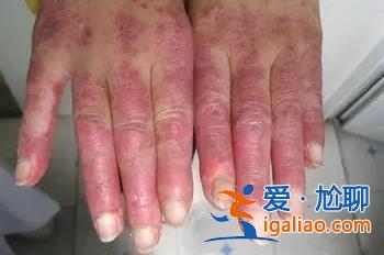 女孩手上長紅斑狼瘡為何會誤以為是凍瘡早期很難被發(fā)現(xiàn)[誤以為]？