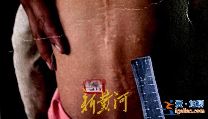 云南3歲女童被槍打傷后與23顆彈片“共生”8年 傷人者被立案后又撤銷？