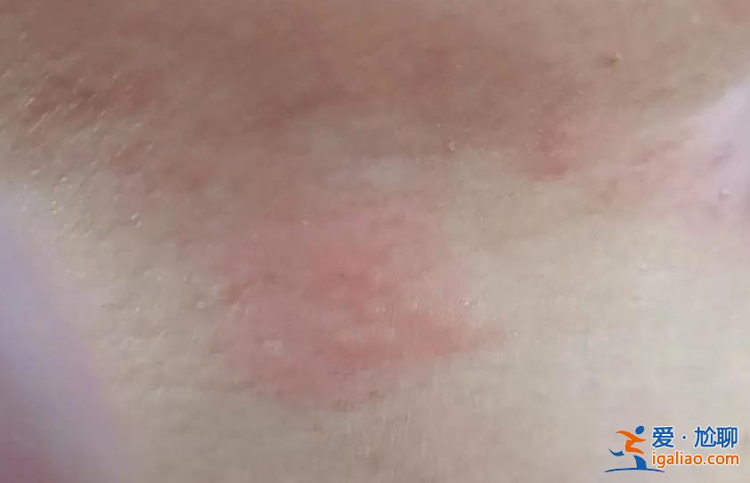 帶狀皰疹一次中招終身免疫？真實(shí)答案是這樣的？